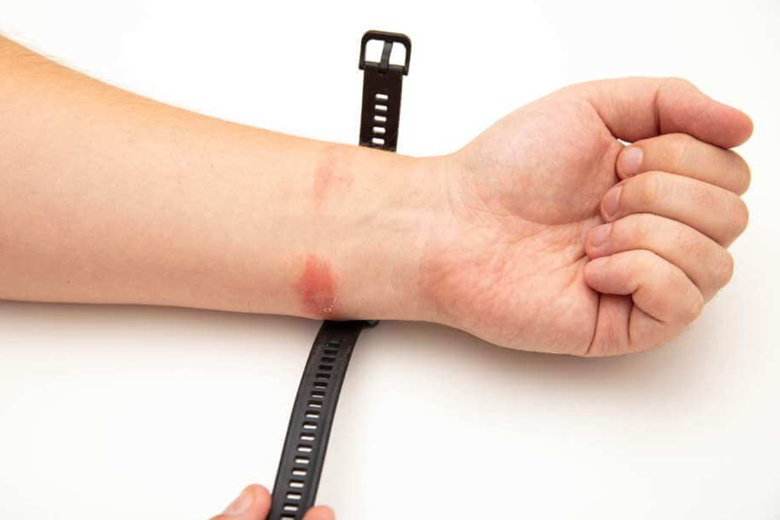Skin irritation with watch band