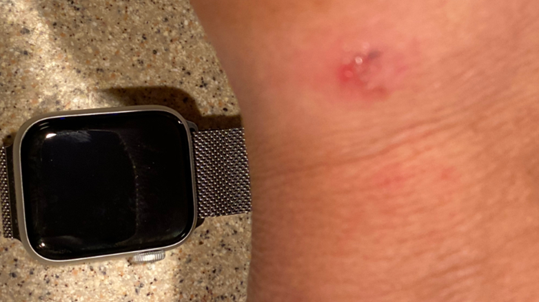 Skin irritation with watch band