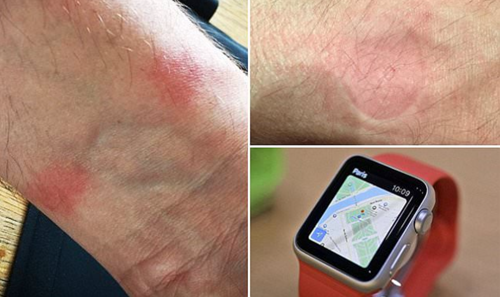 Leather Bands and Allergic Responses