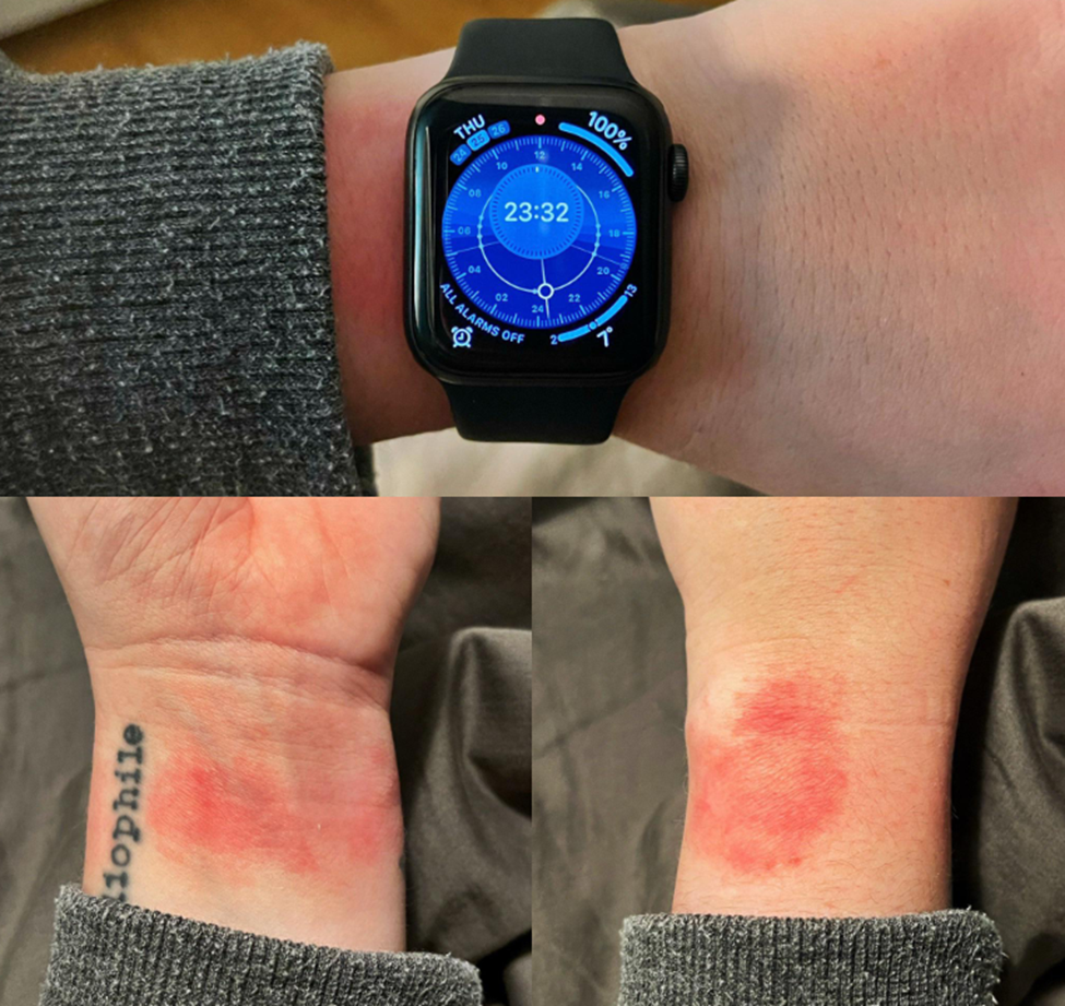 Warning Signs to Stop Wearing Bands